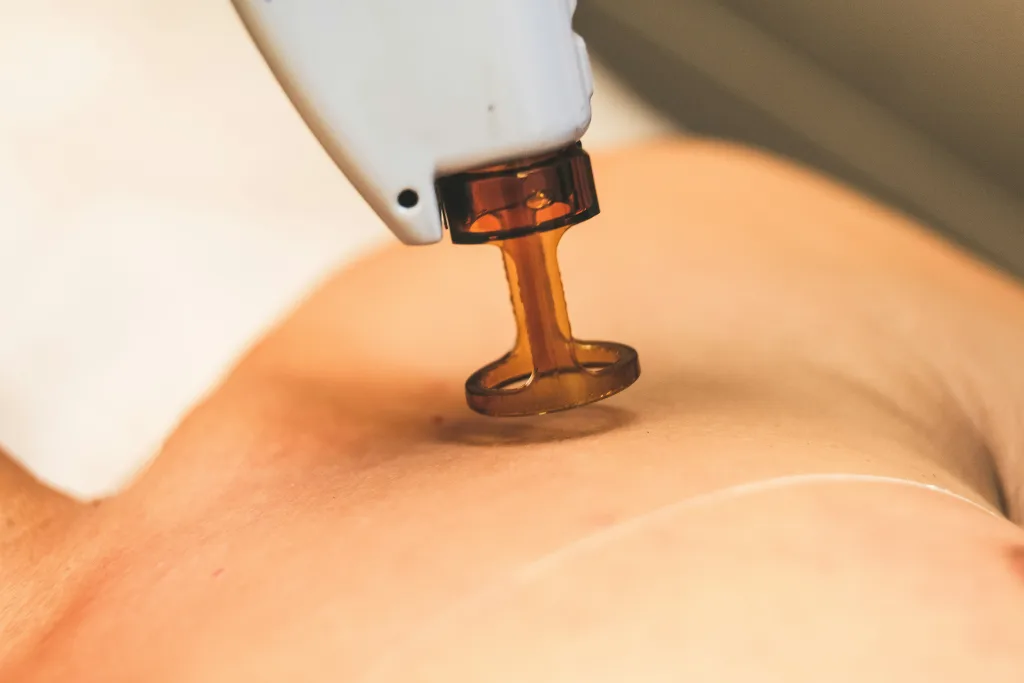 Lasersko odstranjevanje dlak morda ni 100-odstotno trajno za vsakogar v vseh okoli&scaron;činah, je pa najbližje temu idealu, kar nam moderna medicina omogoča. Večina uporabnikov uživa v gladki koži dolga leta, preden potrebujejo kratek "osvežitveni" tretma.