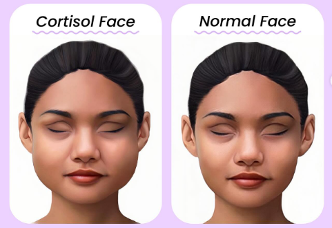 Cortisol face: Kako prepoznaš stresno zabuhlost in jo odpraviš?